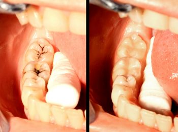 Molar teeth restoration with composite obturation, before and after